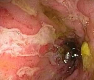 Воспаление и изъязвления слизистой оболочки кишечника при болезни Крона