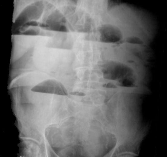Обзорная рентгенограмма при острой кишечной непроходимости