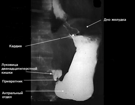 Стеноз привратника желудка на рентгенологическом снимке