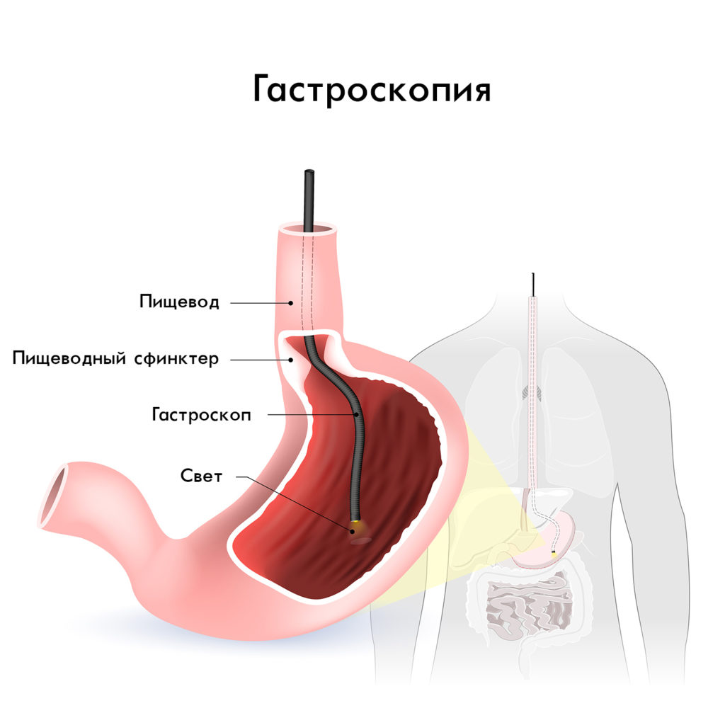 Схематичное изображение анатомии желудка и гастроскопиии