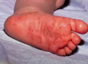На фото высыпания на коже стоп у ребенка при чесотке, медицинская энциклопедия resursor.ru