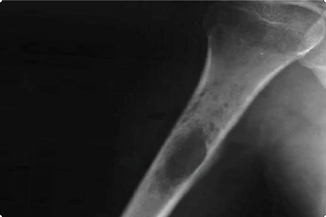 Диагноз саркома. Саркома Юинга мягких тканей. Саркома Юинга плечевой кости рентген. Саркома плечевого сустава рентген.