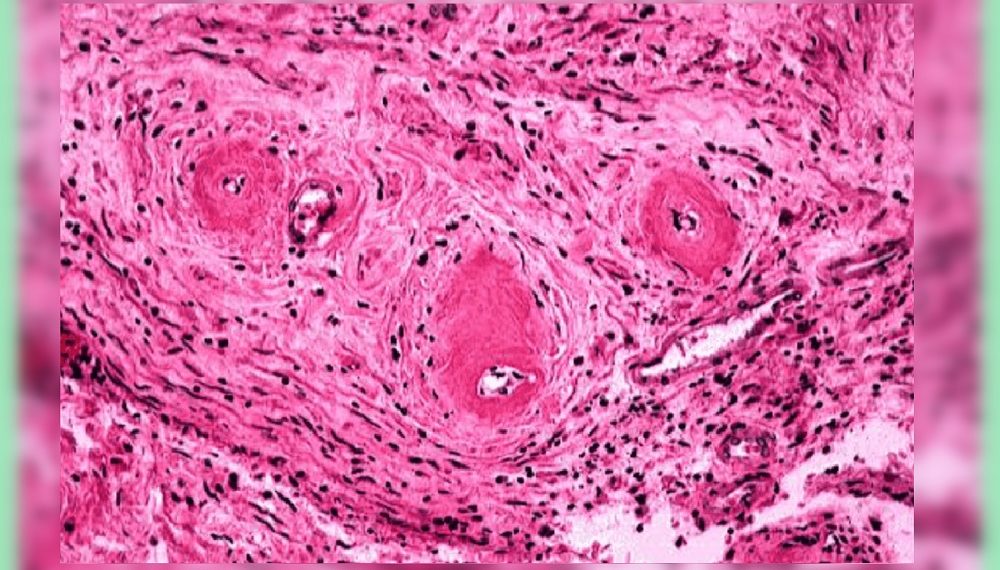 Гистологическая картина гипертонического артериолосклероза