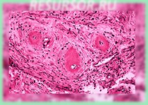 Гистологическая картина гипертонического артериолосклероза