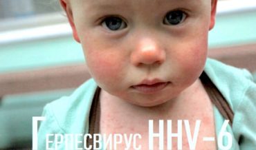 Герпесвирус 6 типа (HHV-6): заболевания им обусловленные, внезапная экзантема